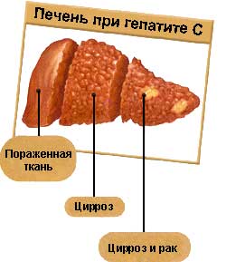 Разрушение стереотипов: государственные клиники и ВГС - фото № 2 Разрушение стереотипов: государственные клиники и ВГС - фото № 2
